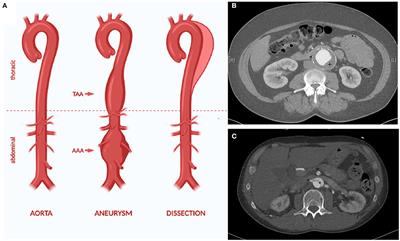 Inflammasome Targeted Therapy as Novel Treatment Option for Aortic Aneurysms and Dissections: A Systematic Review of the Preclinical Evidence